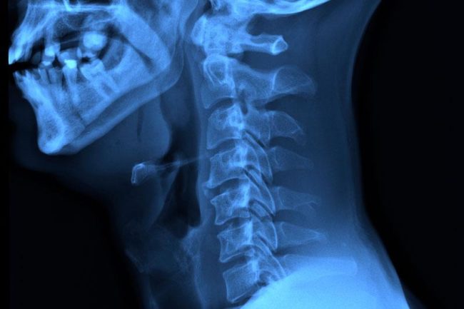 dx spine cervical x ray
